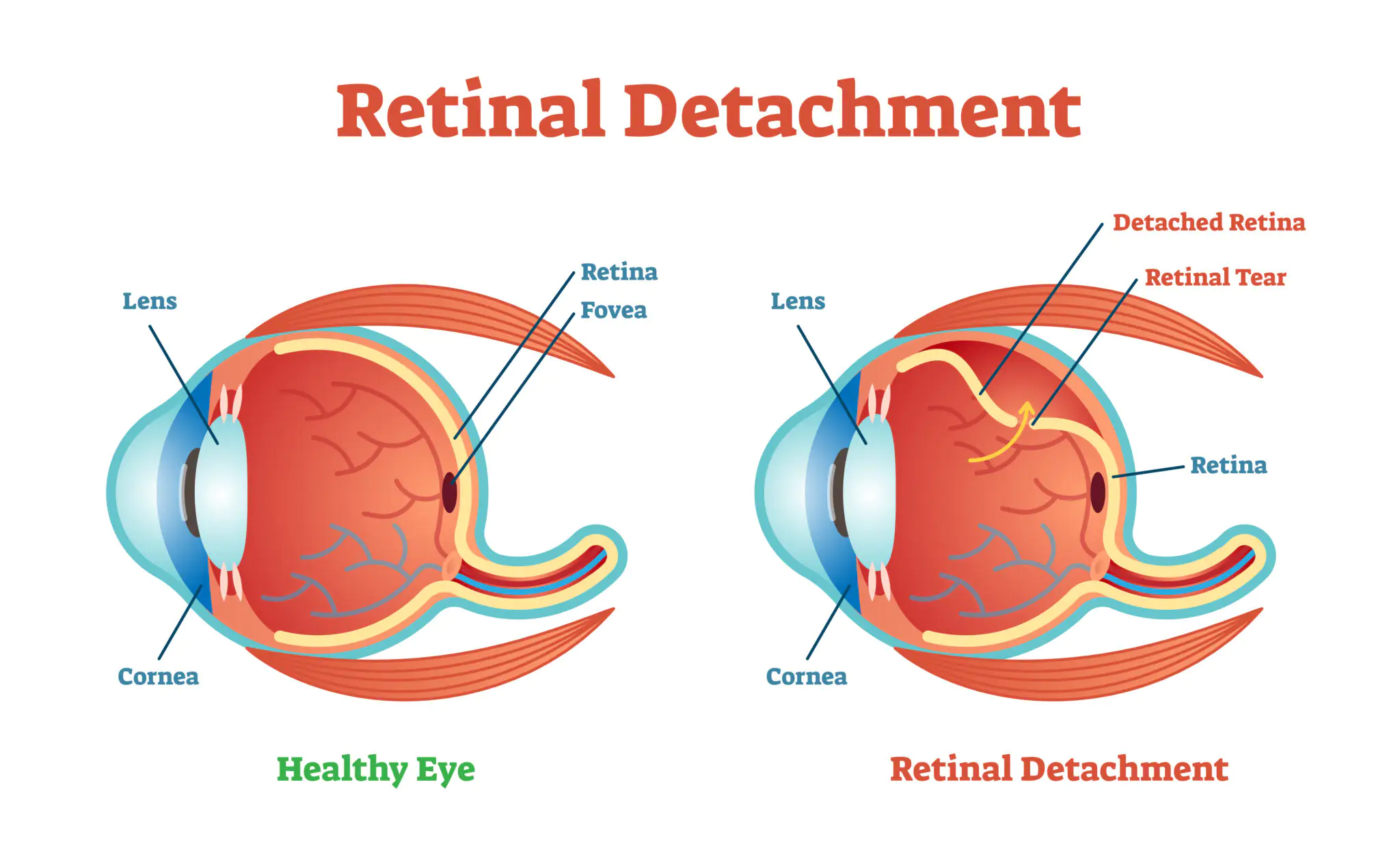 Retinal Detachment: Types, Symptoms, and Treatments