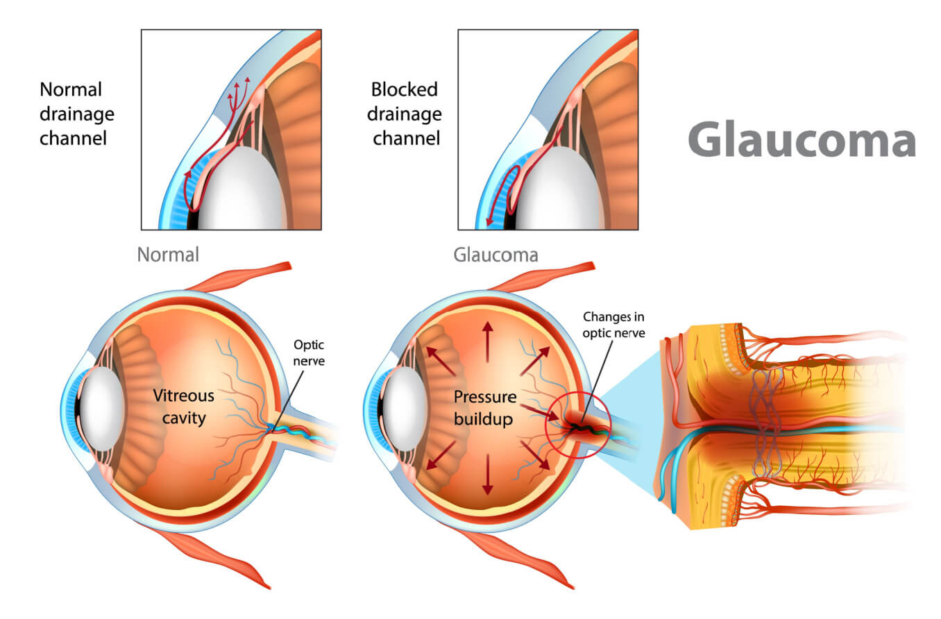 Glaucoma: A Wake-Up Call for Awareness